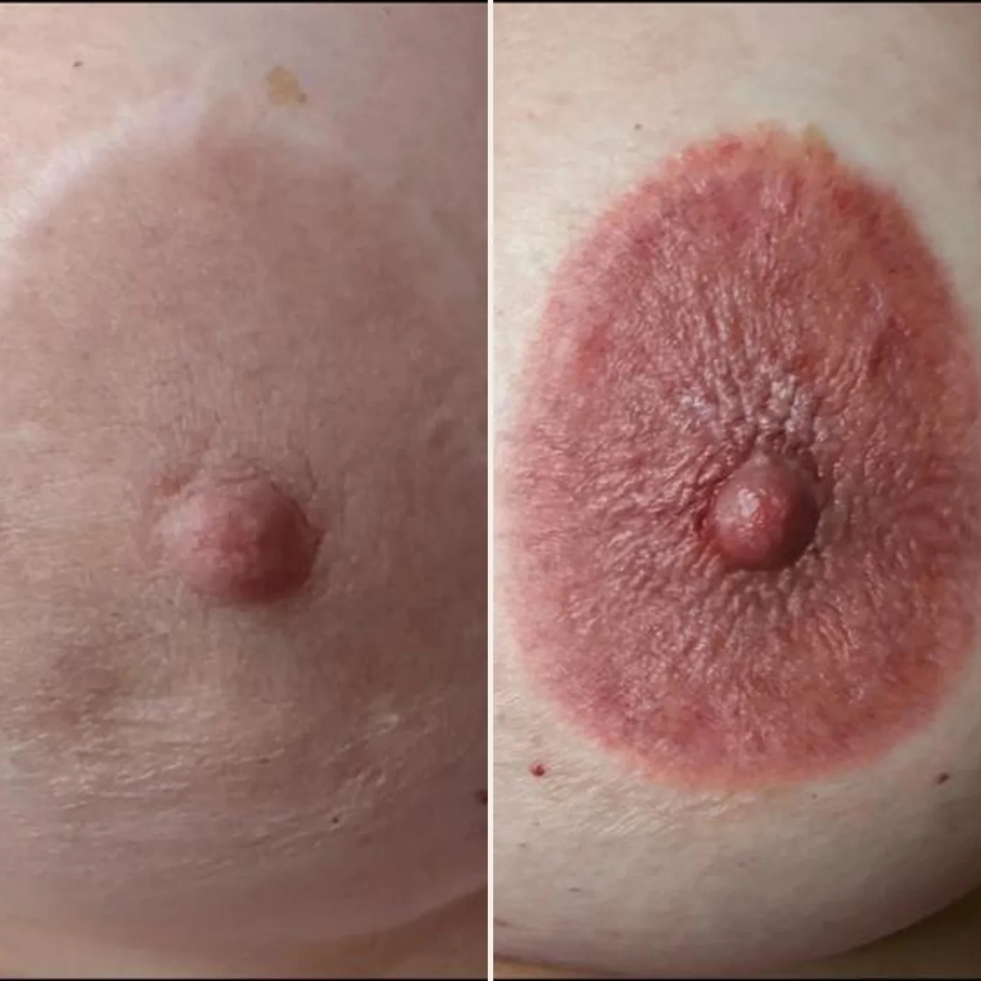 Pale flat areola before, fuller pigmented areola after repigmentation — MB Beauty, Las Vegas