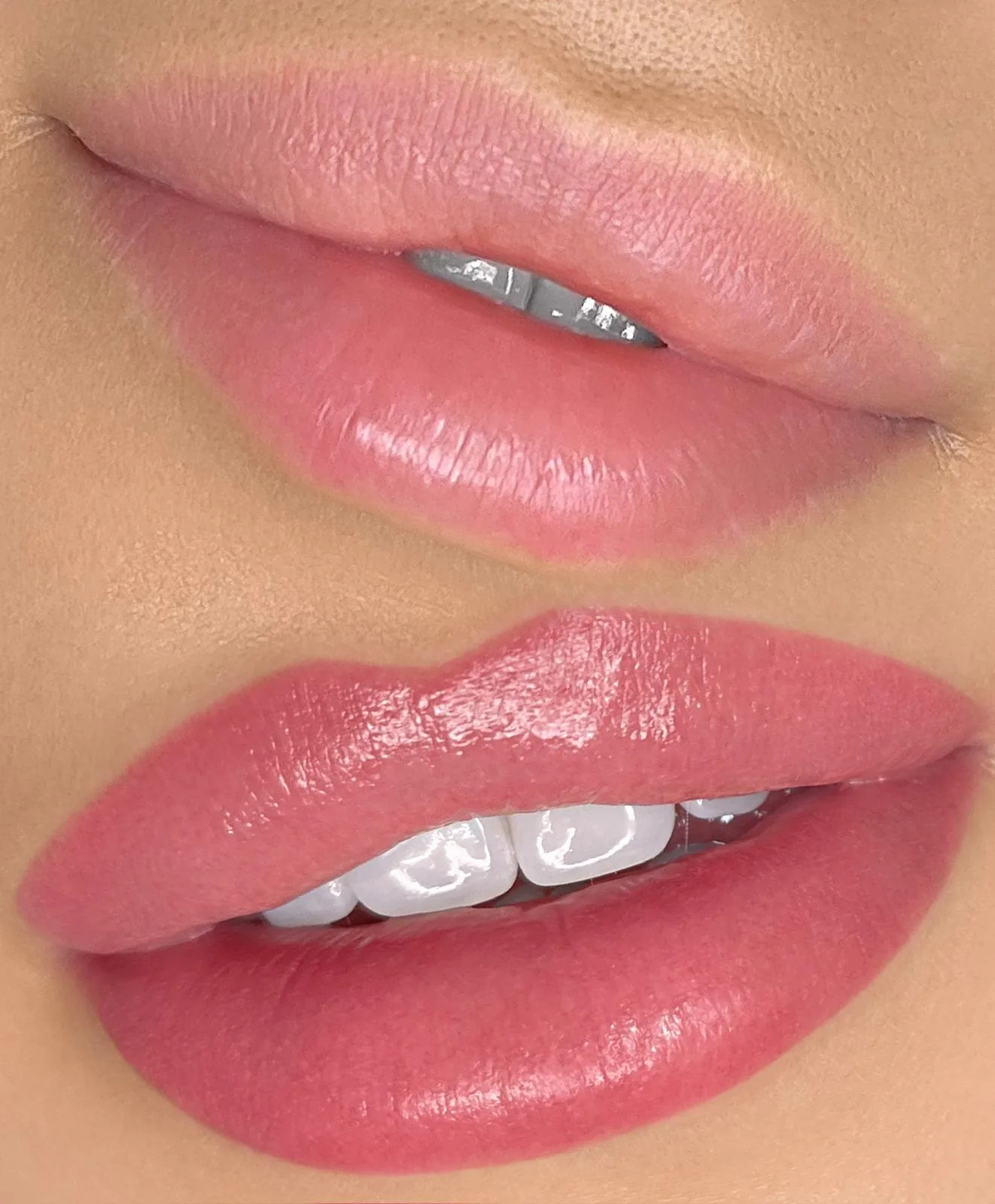 Lips before/after