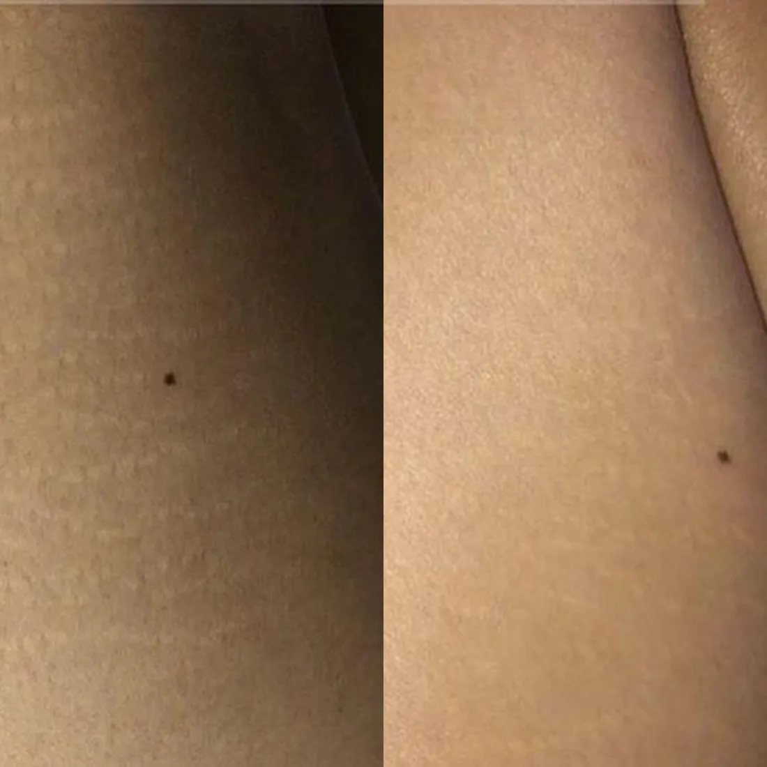Stretch marks on the upper thigh before camouflage, evened out with the surrounding skin after — MB Beauty, Las Vegas